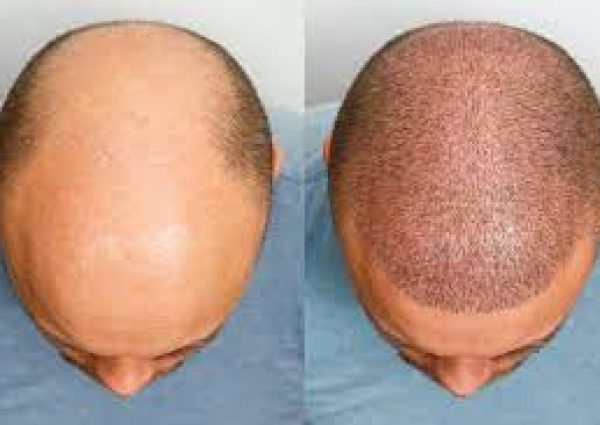 Haartransplantatie Haartransplantatie